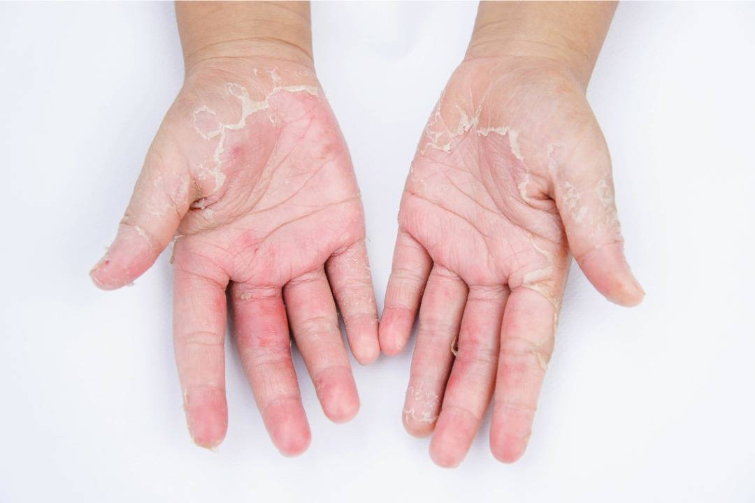 What Goes Wrong When You Treat a Fungal Skin Infection at Home