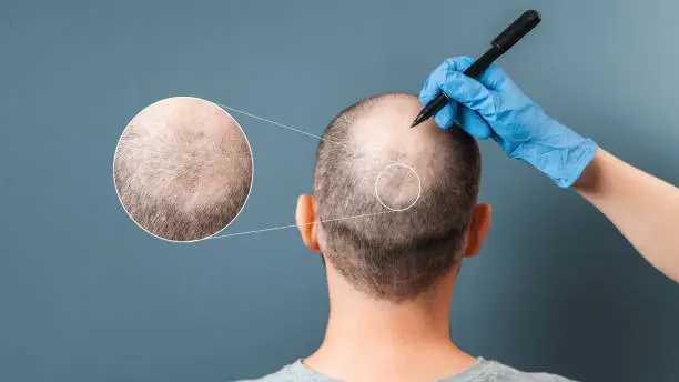 FUE vs DHI Hair Transplantation: A Technique Primer for Medical Students