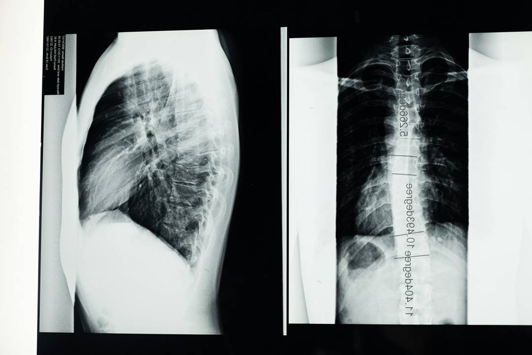Clinical Indicators Prompting Secondary Surgical Intervention in Spinal Care