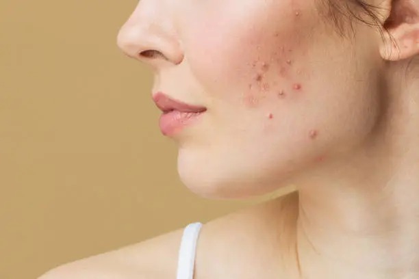 Why dark marks stay long after acne clears, and what actually fades them