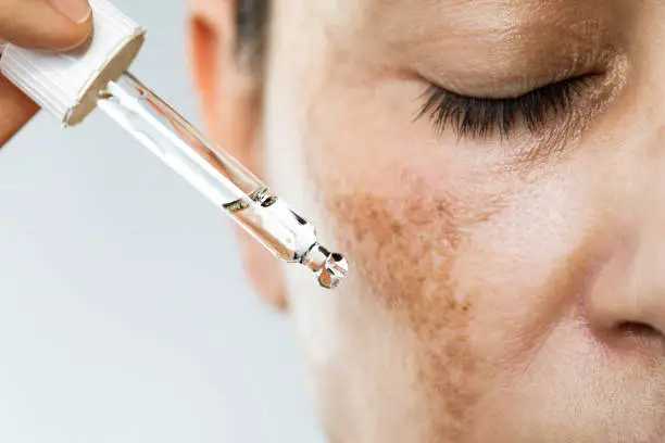 The Dark Spot Dilemma: Why Hyperpigmentation Is So Difficult to Treat and What Actually Works