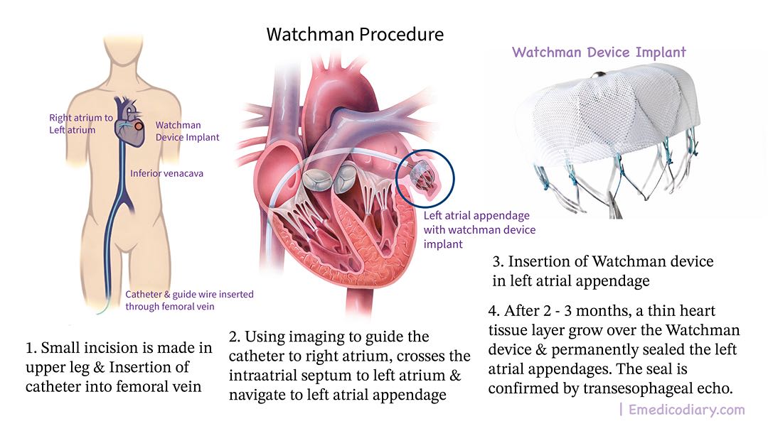 Watchman Procedure