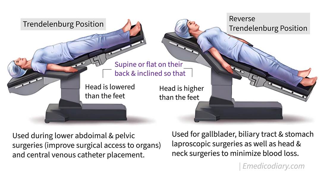 Trendelenburg Position Emedicodiary