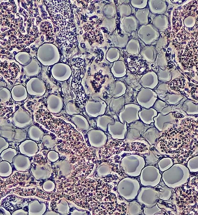 The Role of Single Cell Omics in Infectious Disease Research and Management