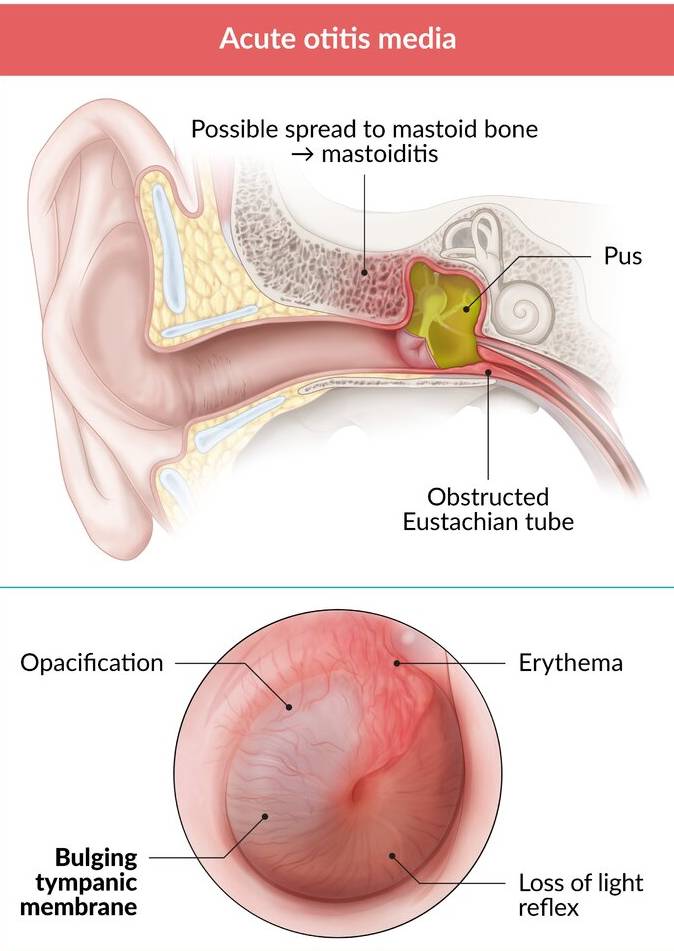 Download Acute Suppurative Otitis Media (ASOM) PDF
