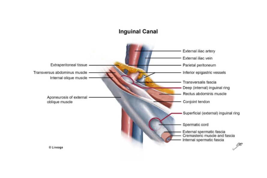 Inguinal Hernia Anatomy | AccessMedicine Network