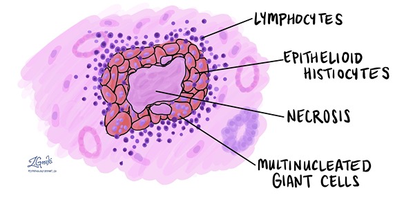 chronic-inflammation-emedicodiary